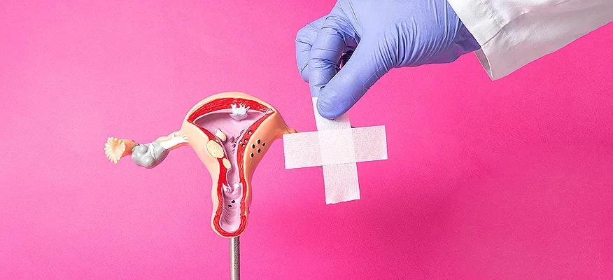 Fibroids and their Journey Post-Menopause